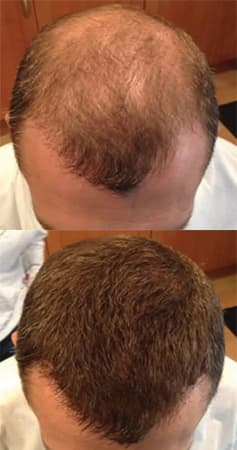 Before and after coverage of a thinning crown