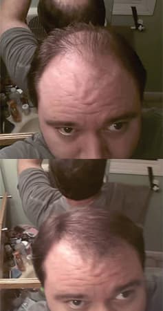 Before and after coverage along the hairline